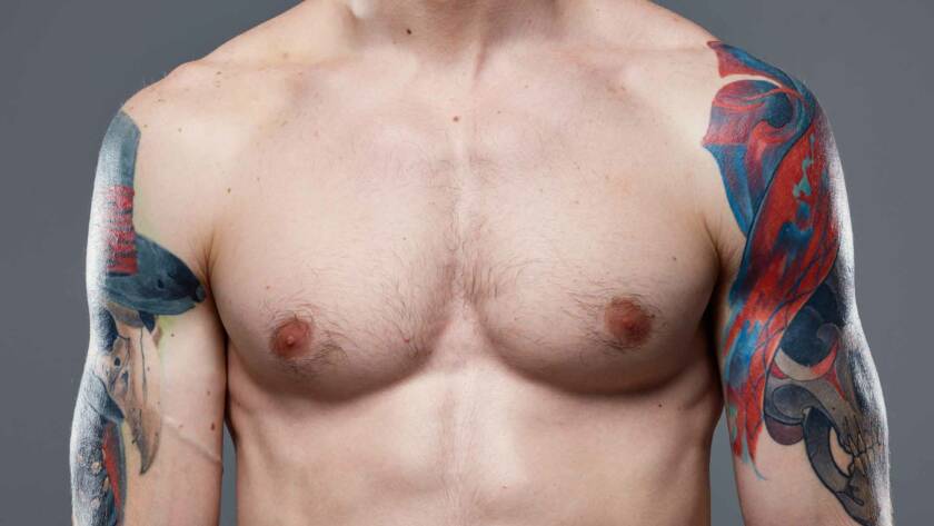 Gynecomastia surgery cost
